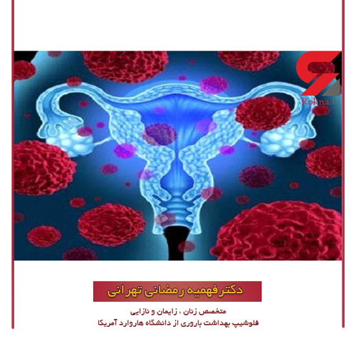 سندرم تخمدان پلی کیستیک