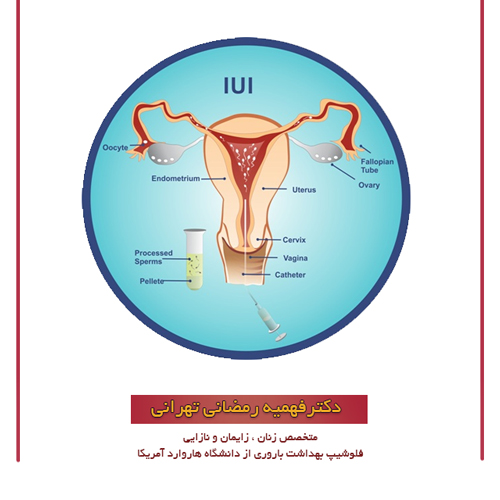درمان ناباروری با iui