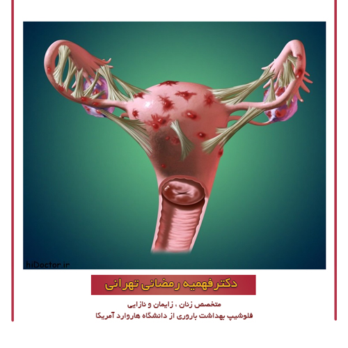 درمان آندومتریوز