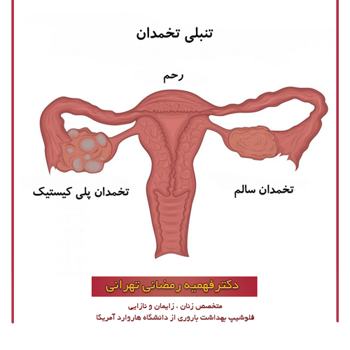 درمان تنبلی تخمدان