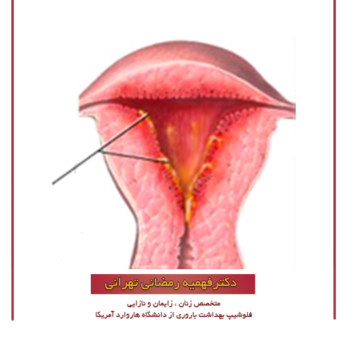 درمان عفونت زنان