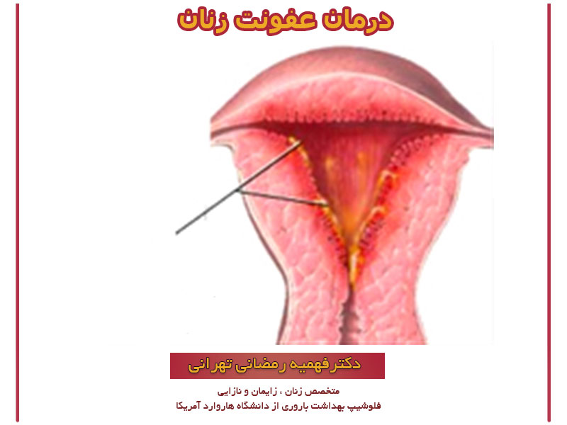 درمان عفونت زنان