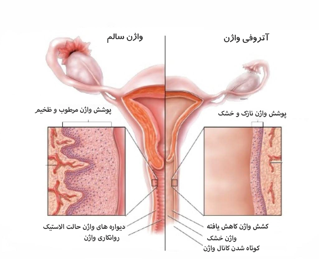 درمان قطعی خشکی واژن 